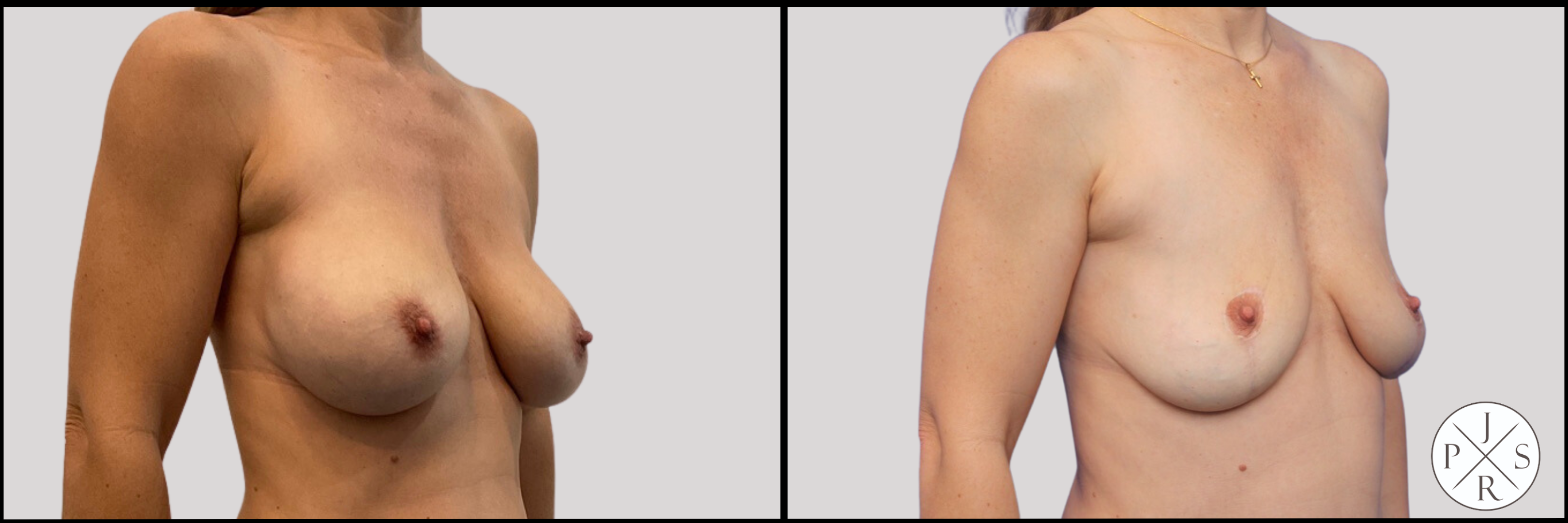 Breast Implant Removal Before & After Image